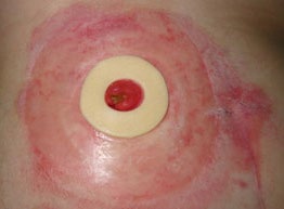 eakin seal on a stoma