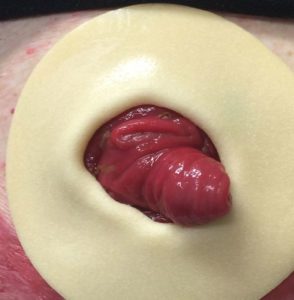 eakin stoma treating reddened peristomal cohesive welland
