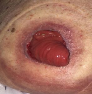 stoma after using eakin cohesive seal