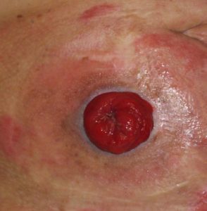 stoma picture