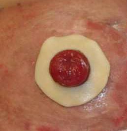 stoma with an eakin seal around it